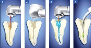 Root Canal Treatments in Delhi/NCR